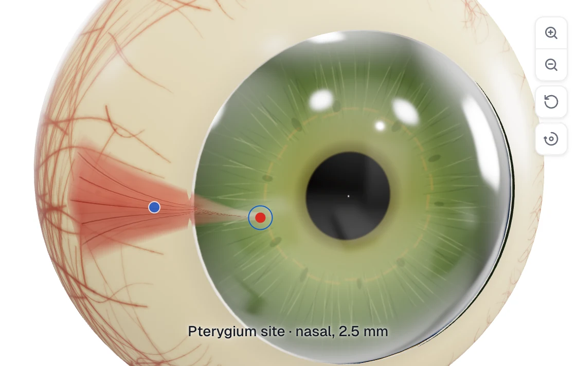 Zoomed procedural eye close-up showing scleral vessels, the nasal feeder corridor, and the pterygium wedge